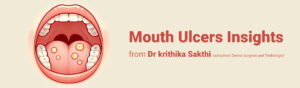 Mouth Ulcers Insights